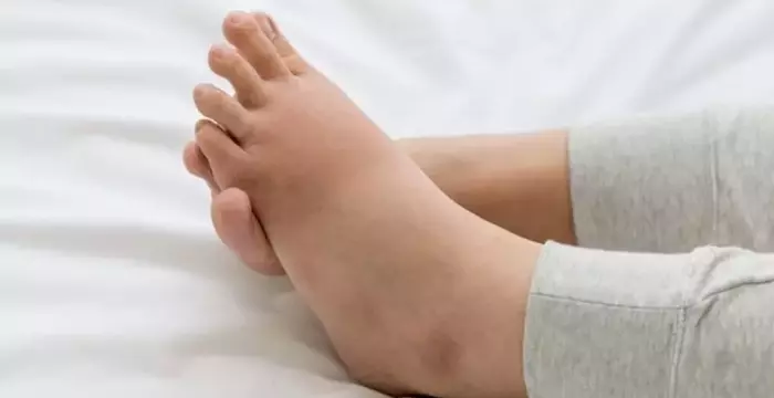 Relief from Angioedema: Feel Better Today