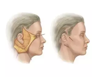 What is a facelift? Let's explain it all at once.